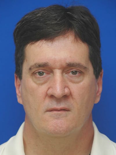 Face Lift Before & After Gallery - Patient 247584 - Image 1
