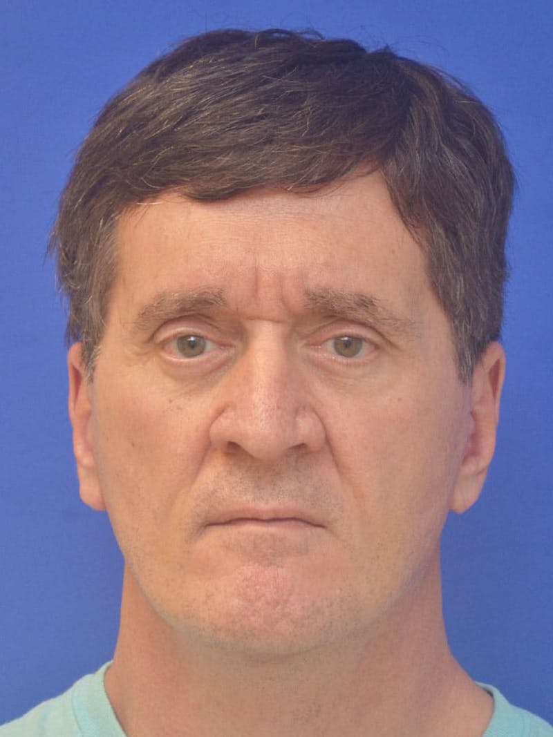 Face Lift Before & After Gallery - Patient 247584 - Image 2