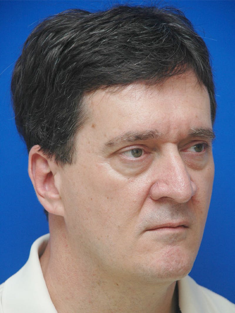 Face Lift Before & After Gallery - Patient 247584 - Image 3