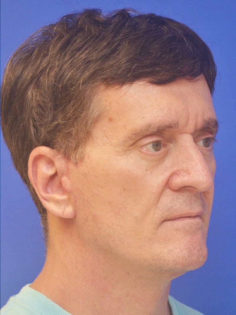 Face Lift Before & After Gallery - Patient 247584 - Image 4