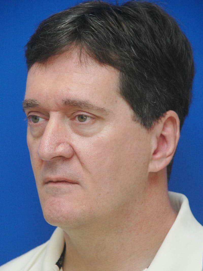 Face Lift Before & After Gallery - Patient 247584 - Image 5