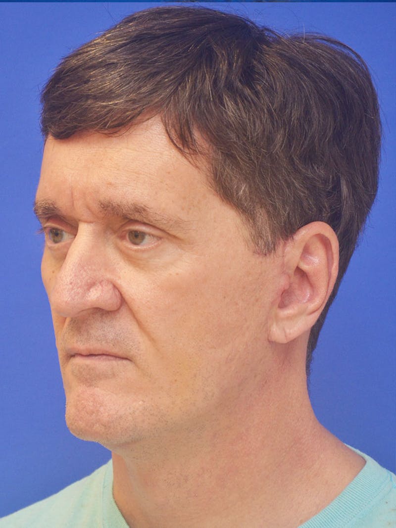 Face Lift Before & After Gallery - Patient 247584 - Image 6
