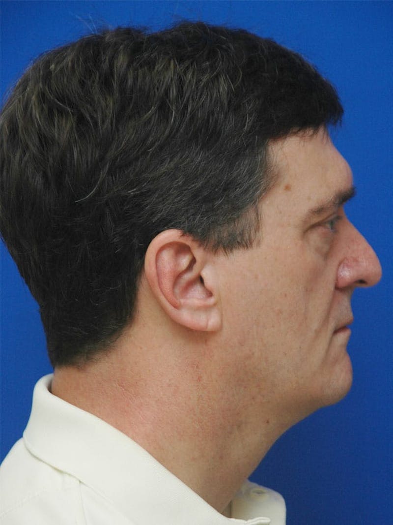 Face Lift Before & After Gallery - Patient 247584 - Image 7