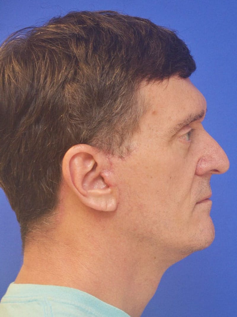 Face Lift Before & After Gallery - Patient 247584 - Image 8