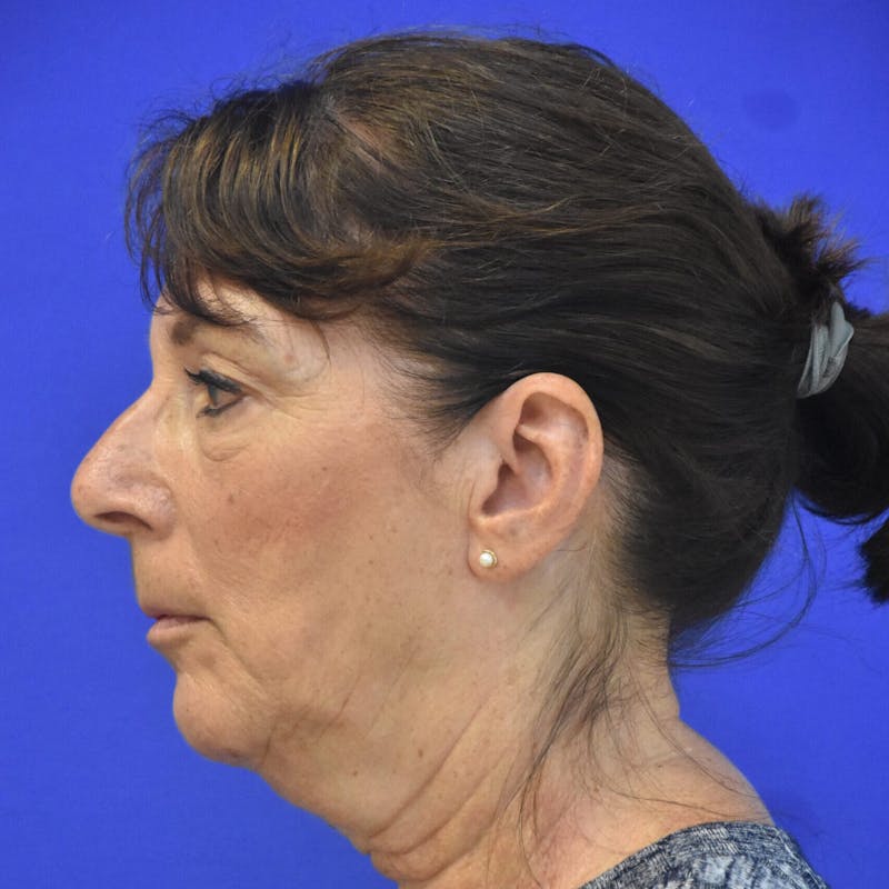 Face Lift Before & After Gallery - Patient 147327 - Image 1