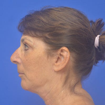 Face Lift Before & After Gallery - Patient 147327 - Image 2
