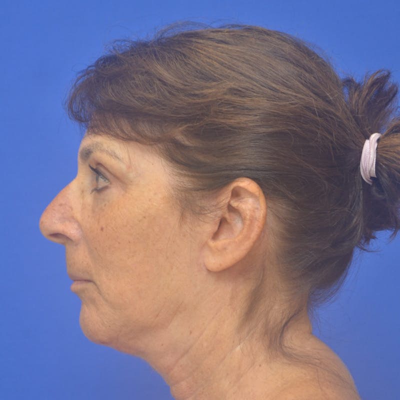 Face Lift Before & After Gallery - Patient 147327 - Image 2