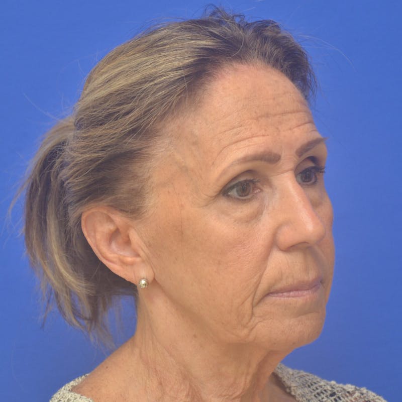 Face Lift Before & After Gallery - Patient 301113 - Image 1