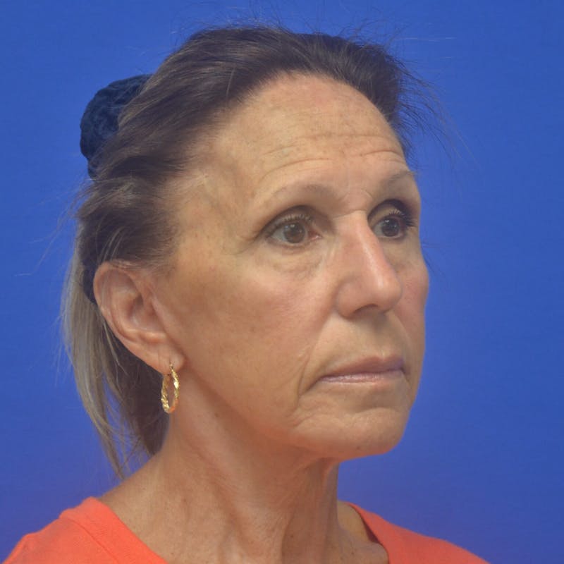 Face Lift Before & After Gallery - Patient 301113 - Image 2