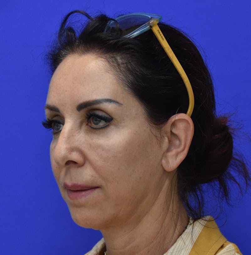 Face Lift Before & After Gallery - Patient 516212 - Image 1