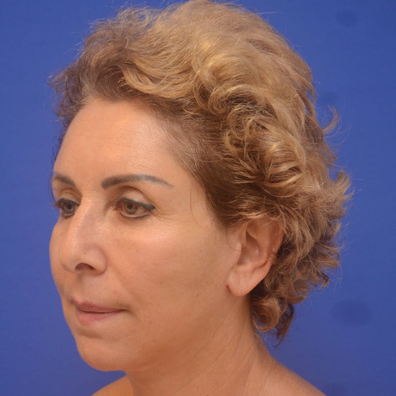 Face Lift Before & After Gallery - Patient 516212 - Image 2