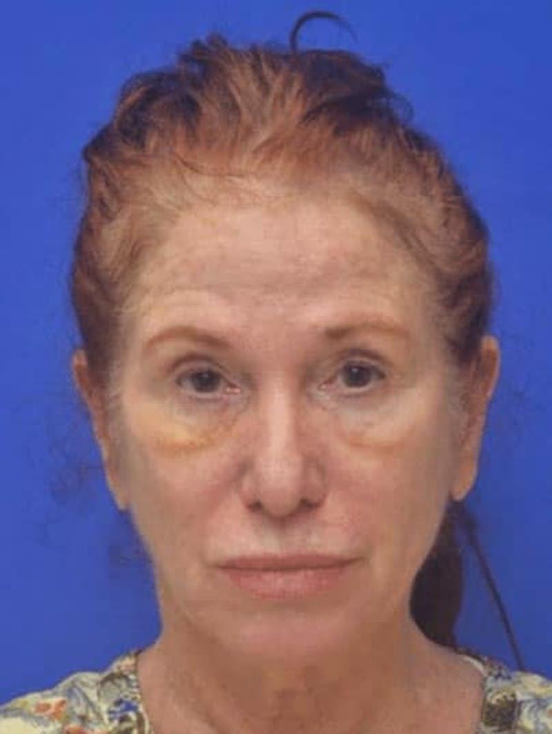 Face Lift Before & After Gallery - Patient 355728 - Image 1