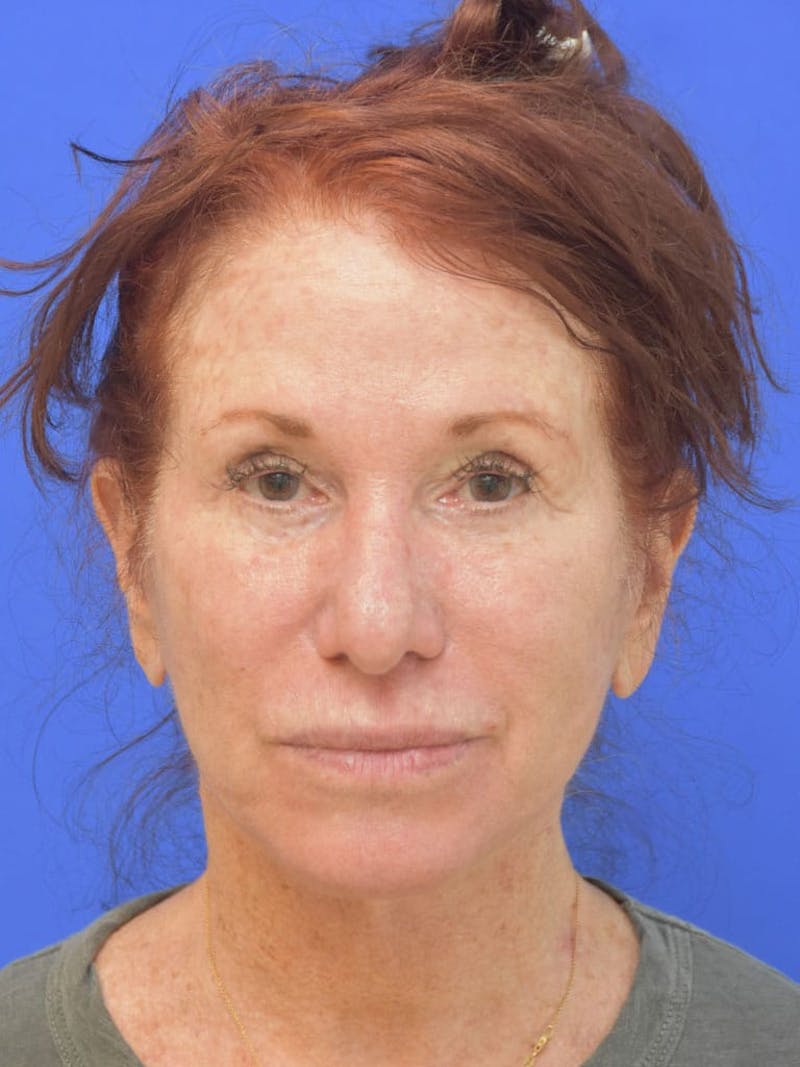 Face Lift Before & After Gallery - Patient 355728 - Image 2