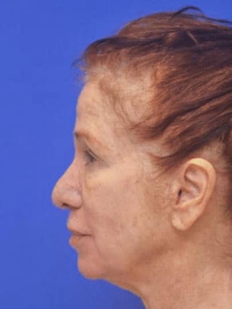 Face Lift Before & After Gallery - Patient 355728 - Image 3