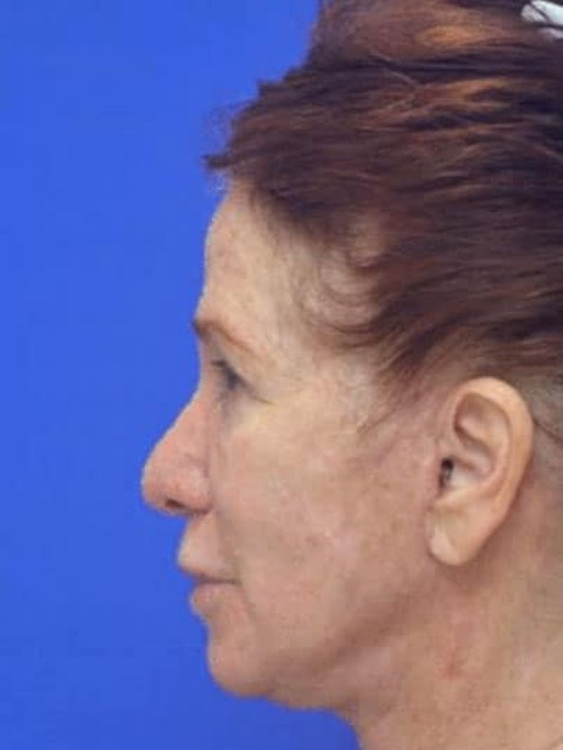 Face Lift Before & After Gallery - Patient 355728 - Image 4