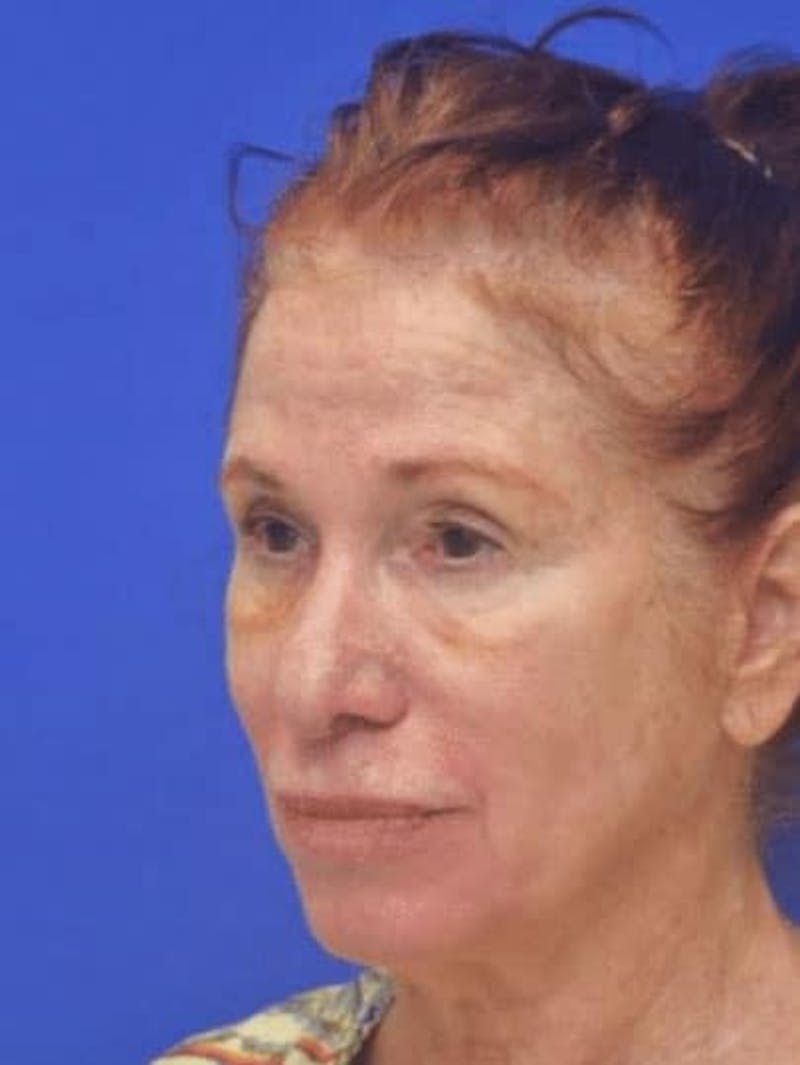 Face Lift Before & After Gallery - Patient 355728 - Image 5