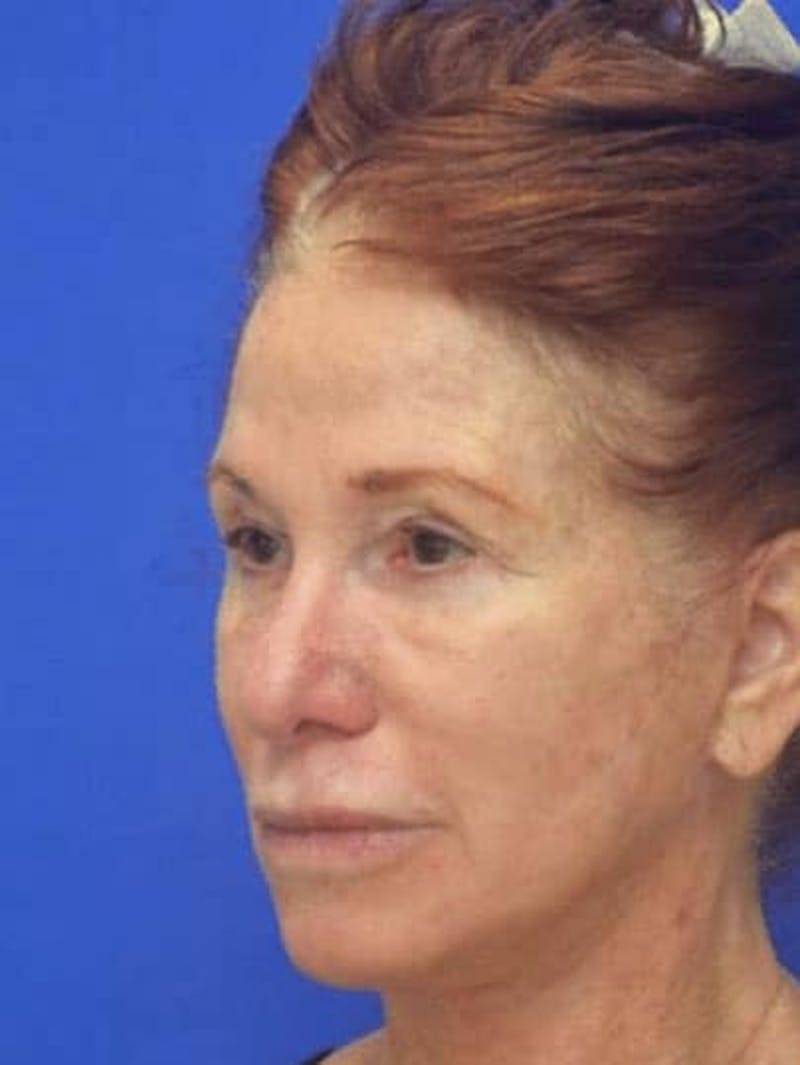 Face Lift Before & After Gallery - Patient 355728 - Image 6