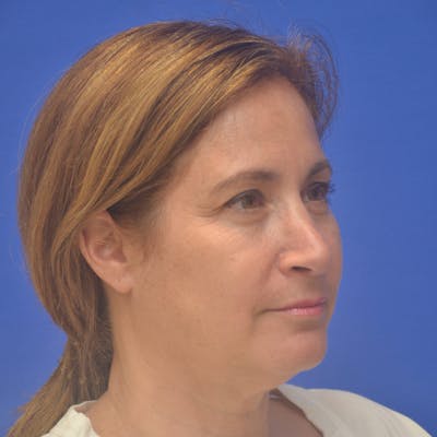 Face Lift Before & After Gallery - Patient 414176 - Image 1