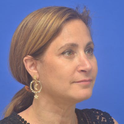 Face Lift Before & After Gallery - Patient 414176 - Image 2