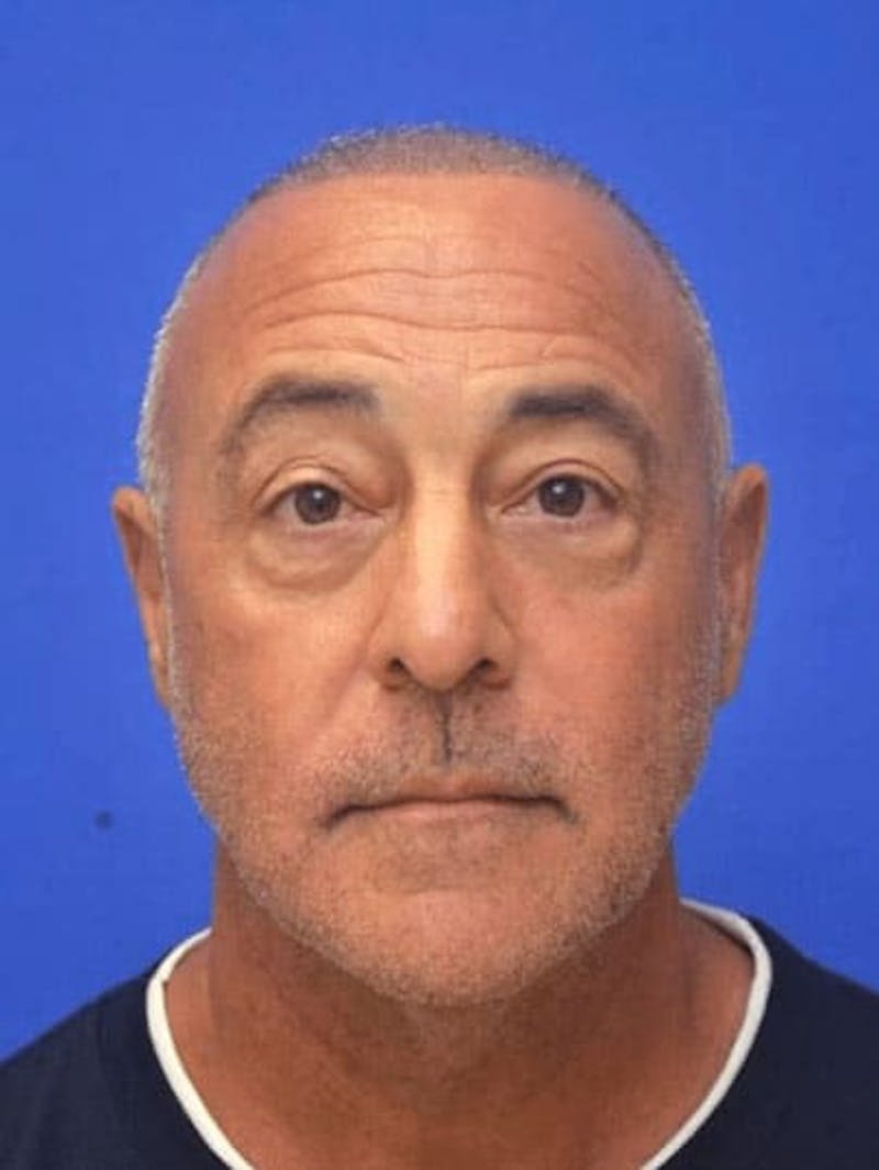 Blepharoplasty Before & After Gallery - Patient 135646 - Image 1