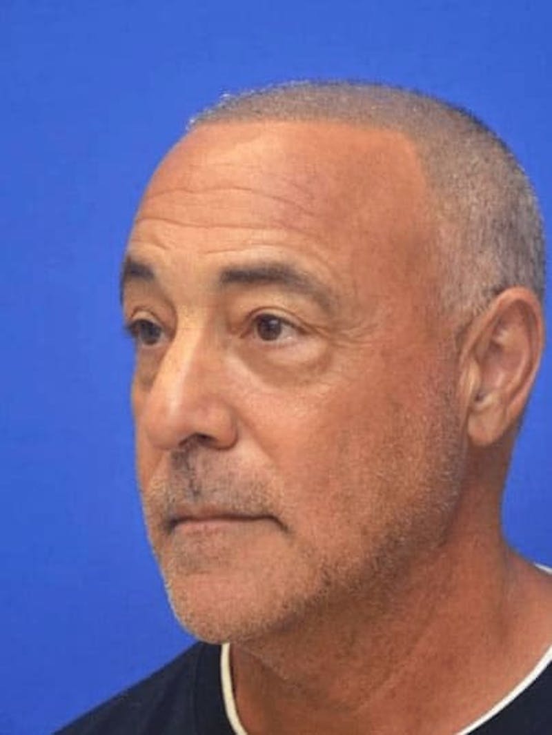 Blepharoplasty Before & After Gallery - Patient 135646 - Image 3