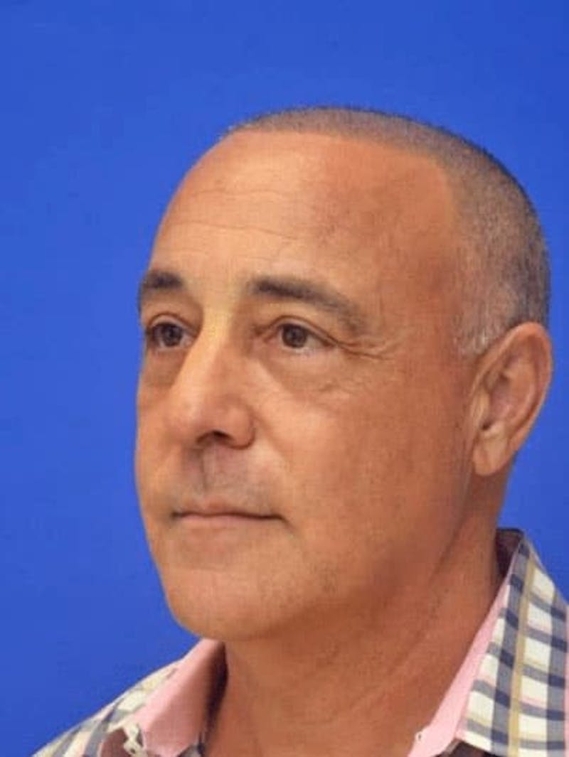 Blepharoplasty Before & After Gallery - Patient 135646 - Image 4