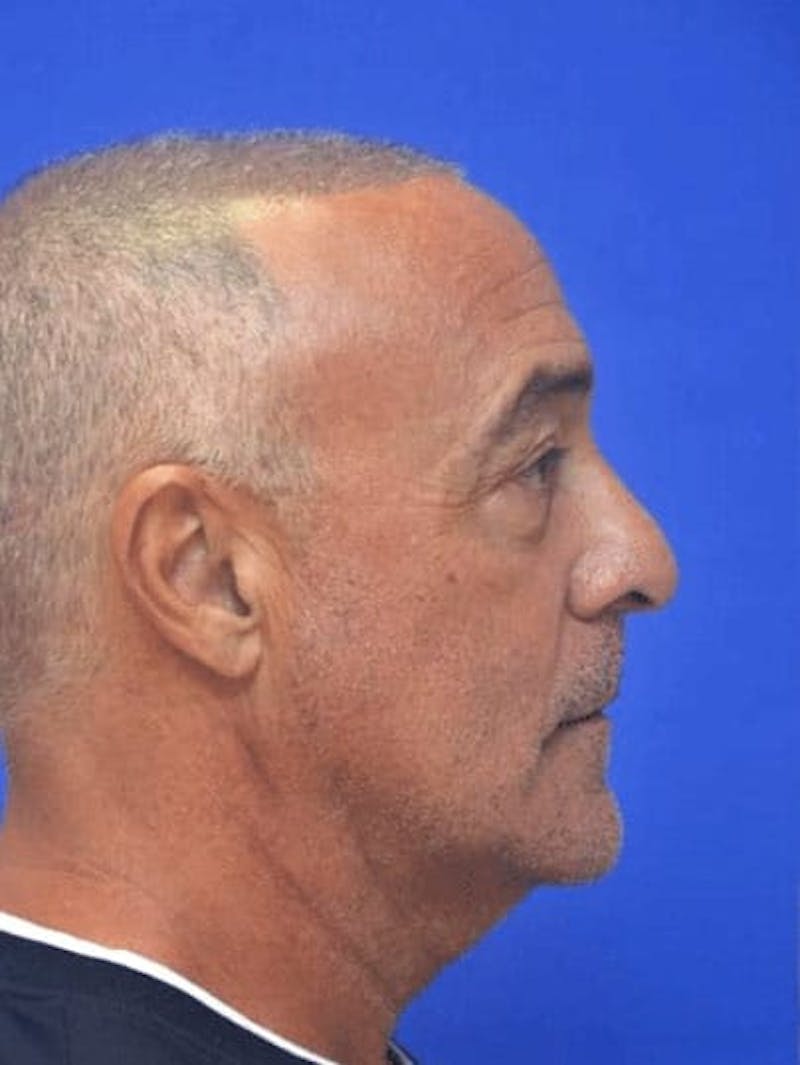 Blepharoplasty Before & After Gallery - Patient 135646 - Image 5