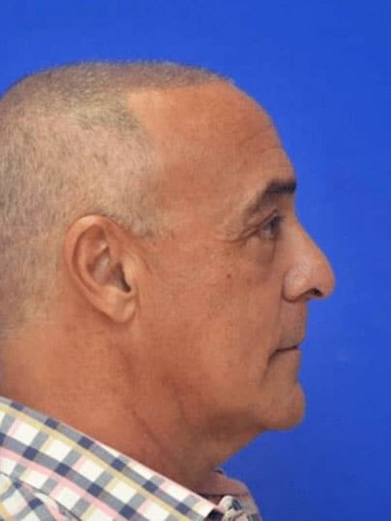 Blepharoplasty Before & After Gallery - Patient 135646 - Image 6