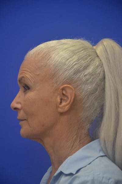 Facelift Before & After Gallery - Patient 308717 - Image 1