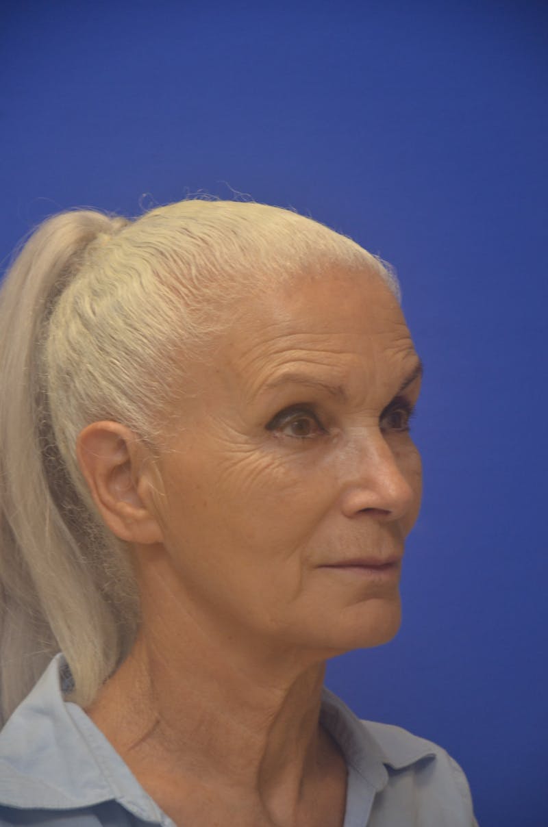 Face Lift Before & After Gallery - Patient 308717 - Image 3