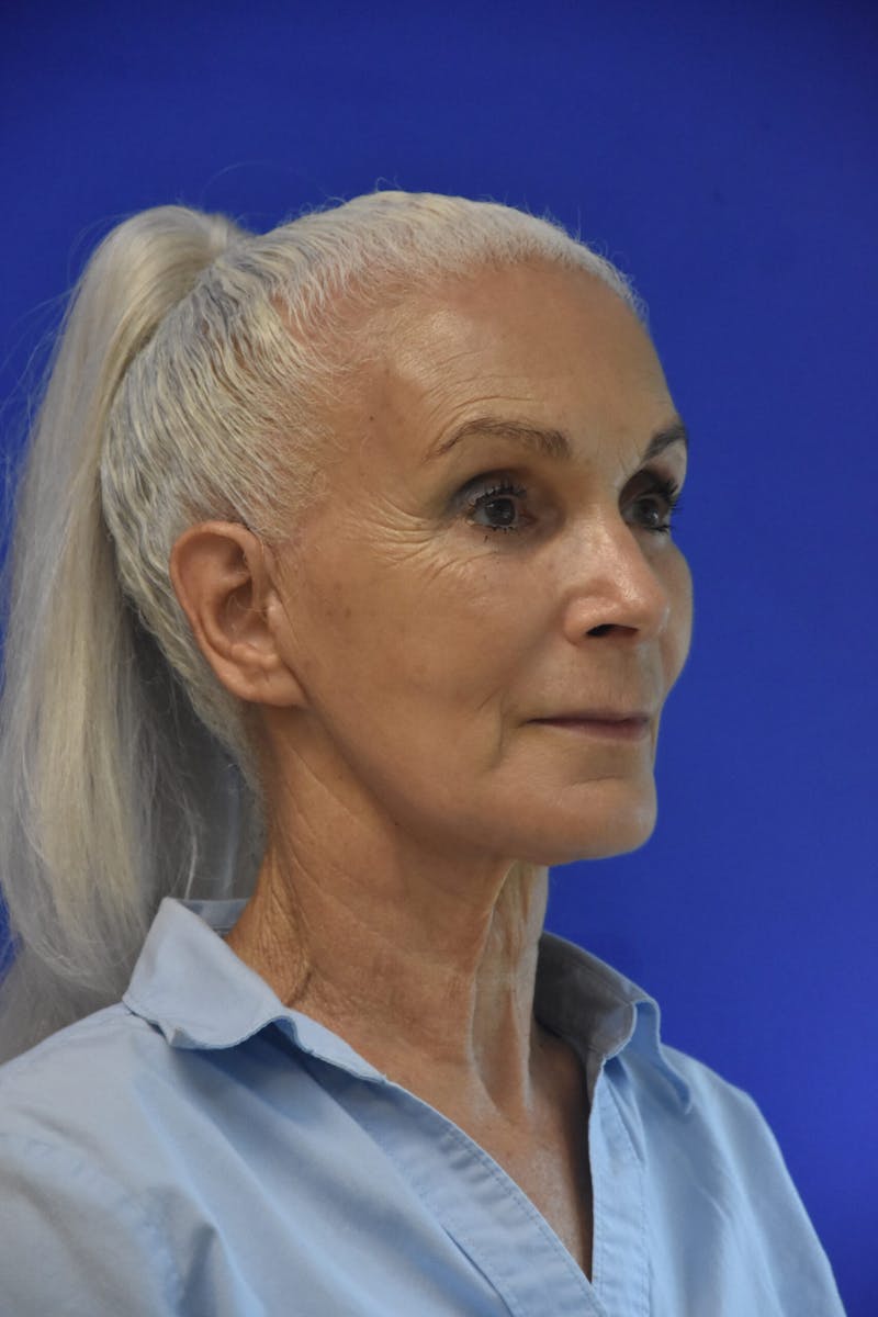 Face Lift Before & After Gallery - Patient 308717 - Image 4