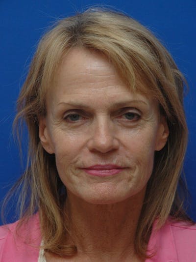 Facelift Before & After Gallery - Patient 261339 - Image 1