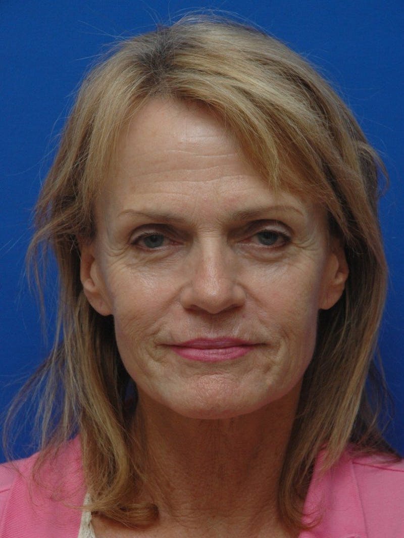 Face Lift Before & After Gallery - Patient 261339 - Image 1
