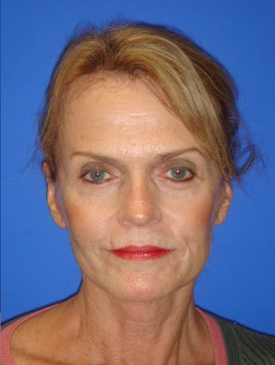 Facelift Before & After Gallery - Patient 261339 - Image 2