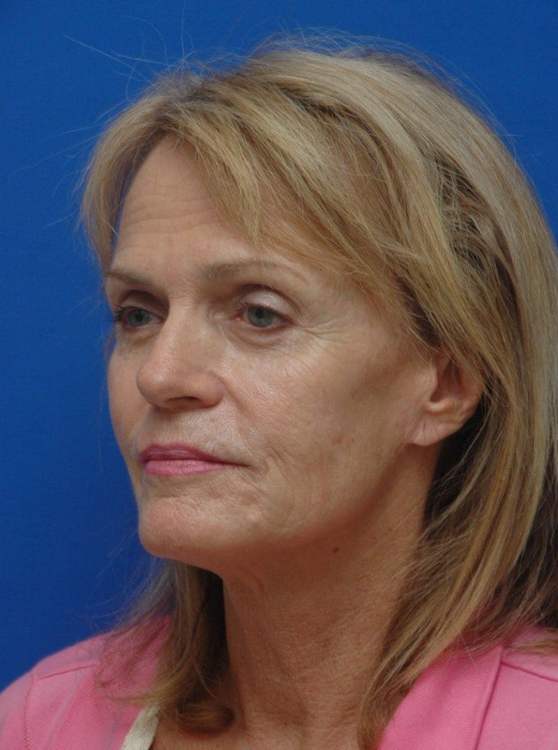 Face Lift Before & After Gallery - Patient 261339 - Image 3