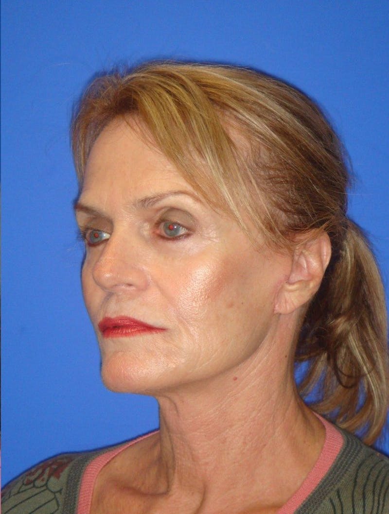 Face Lift Before & After Gallery - Patient 261339 - Image 4