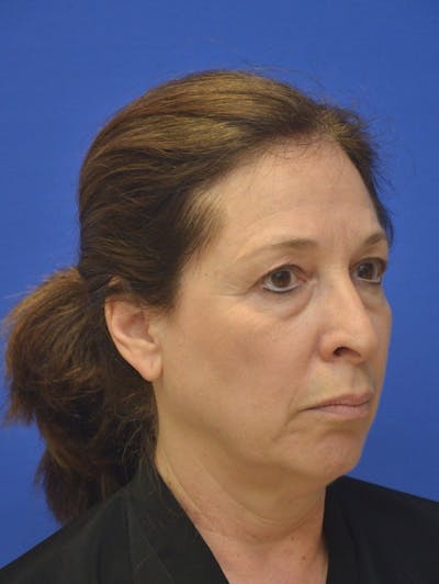 Facelift Before & After Gallery - Patient 234988 - Image 1