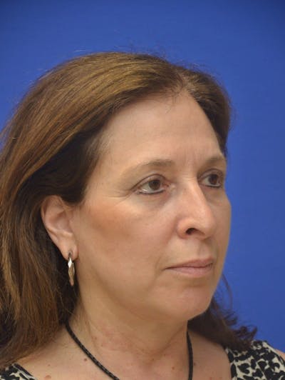 Facelift Before & After Gallery - Patient 234988 - Image 2