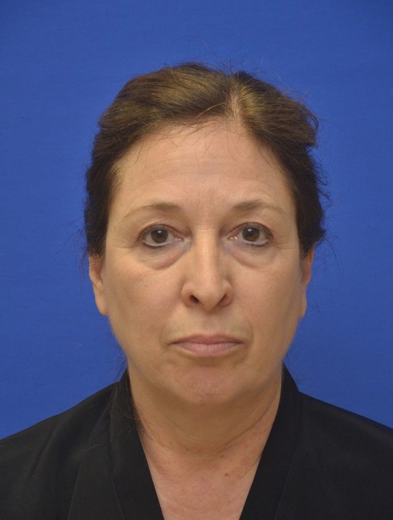 Face Lift Before & After Gallery - Patient 234988 - Image 3