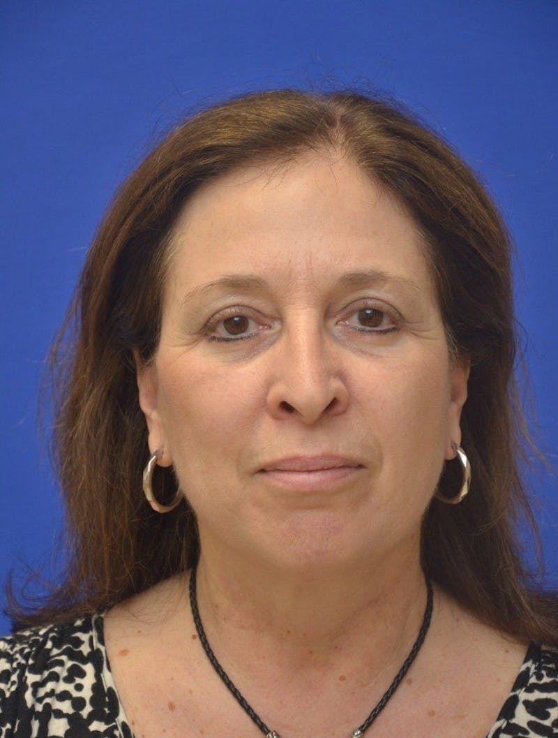 Face Lift Before & After Gallery - Patient 234988 - Image 4