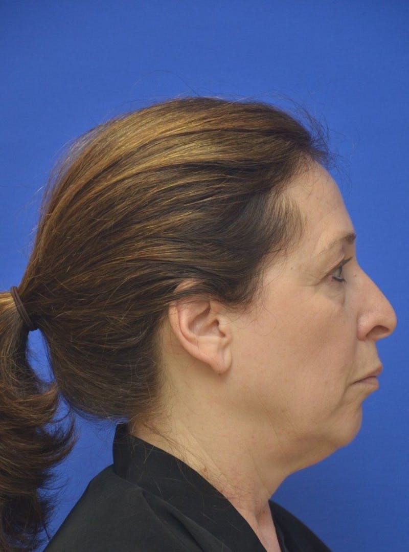 Face Lift Before & After Gallery - Patient 234988 - Image 5