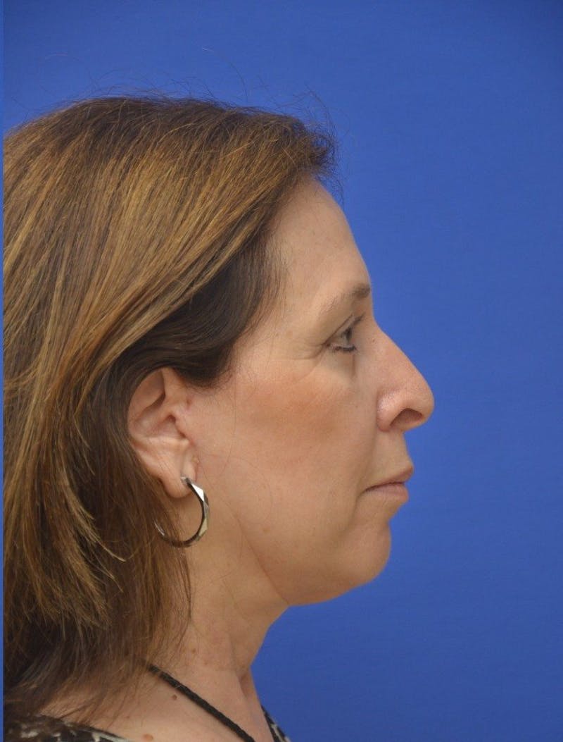 Face Lift Before & After Gallery - Patient 234988 - Image 6