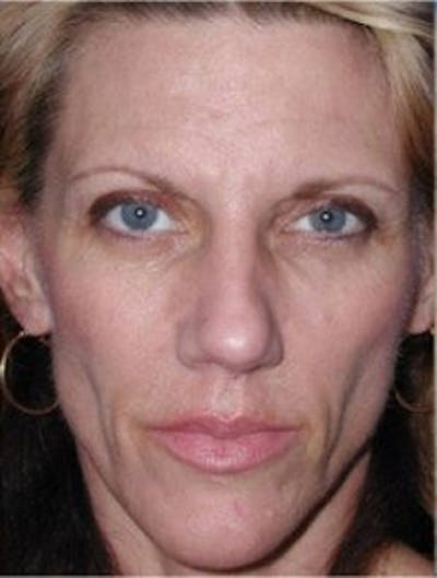 Facelift Before & After Gallery - Patient 289494 - Image 1