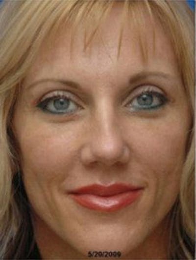 Facelift Before & After Gallery - Patient 289494 - Image 2