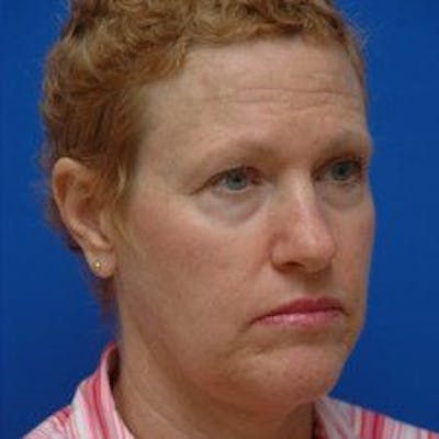 Facelift Before & After Gallery - Patient 278289 - Image 1