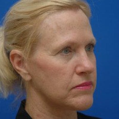 Facelift Before & After Gallery - Patient 278289 - Image 2