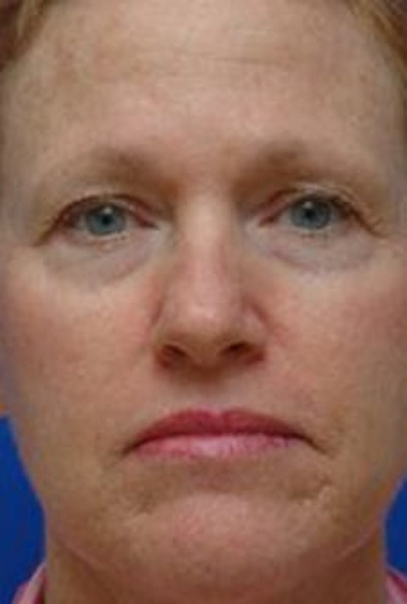 Face Lift Before & After Gallery - Patient 278289 - Image 3