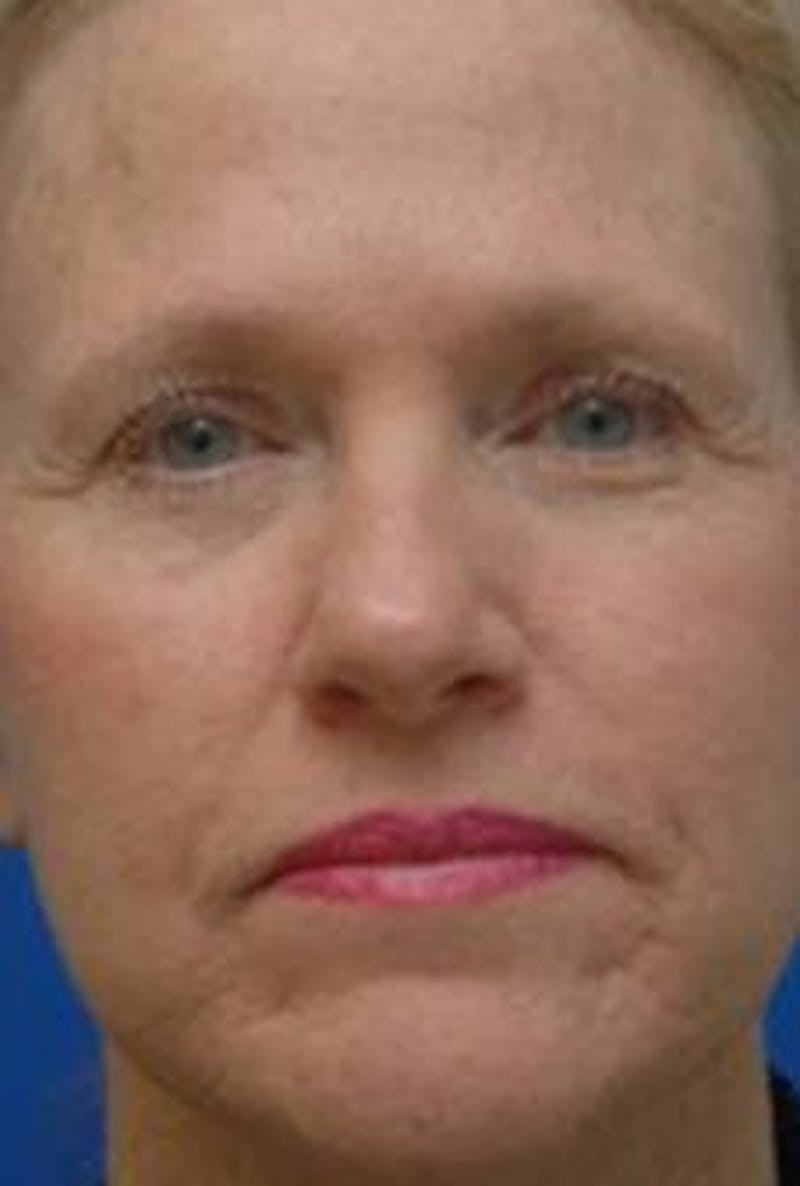 Face Lift Before & After Gallery - Patient 278289 - Image 4