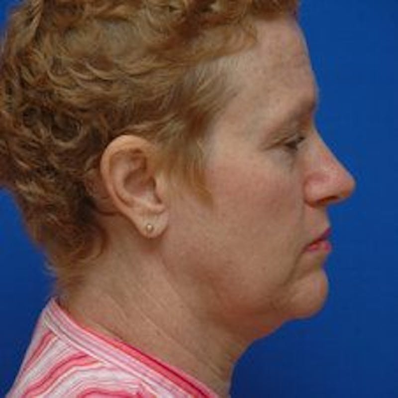 Face Lift Before & After Gallery - Patient 278289 - Image 5