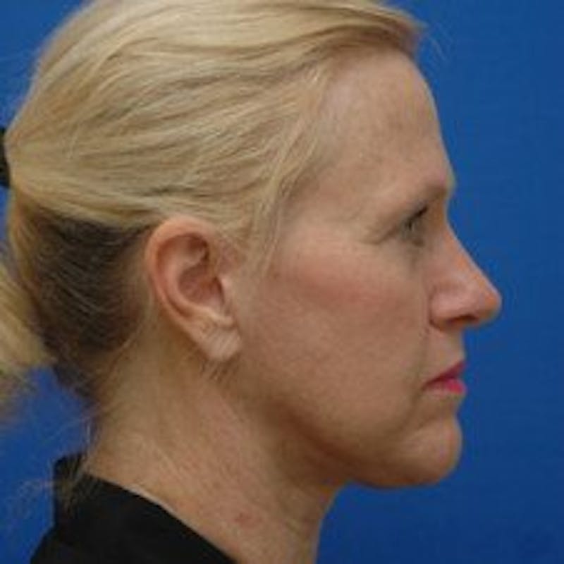 Face Lift Before & After Gallery - Patient 278289 - Image 6